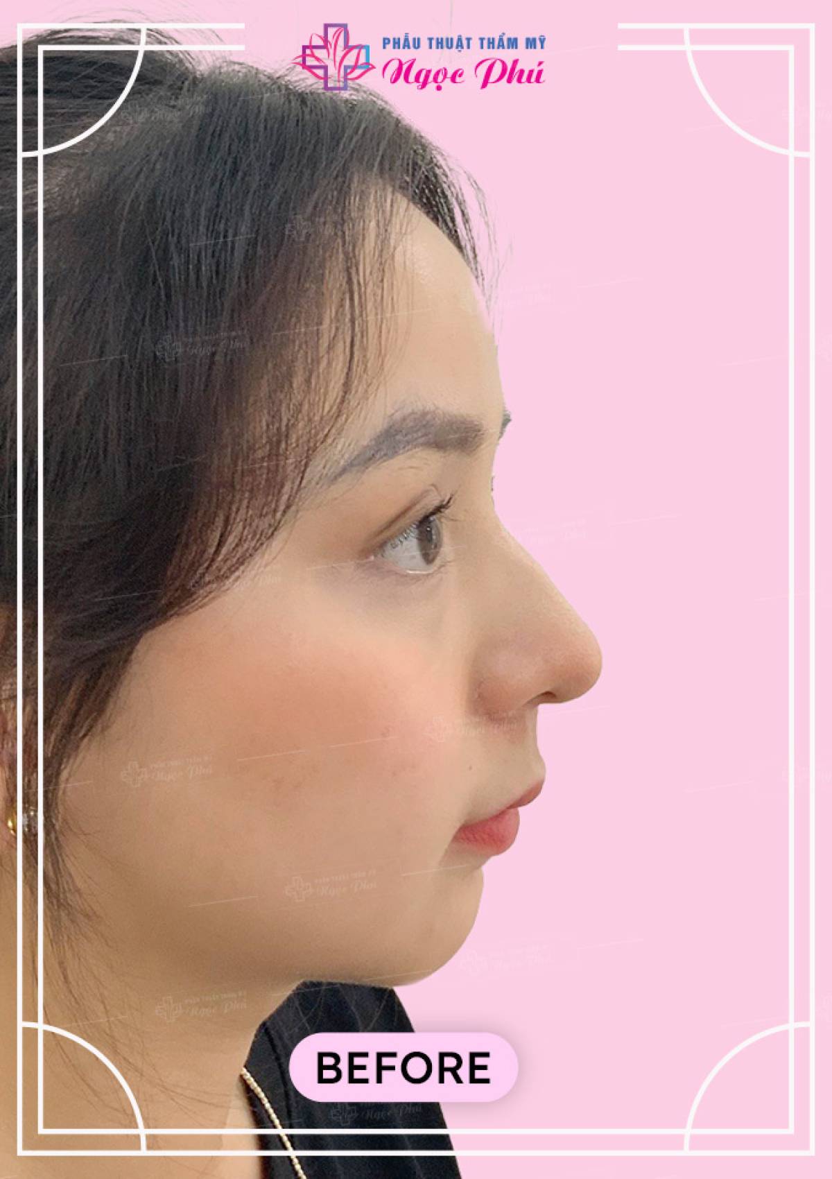 Đặt Cằm Hàn Quốc