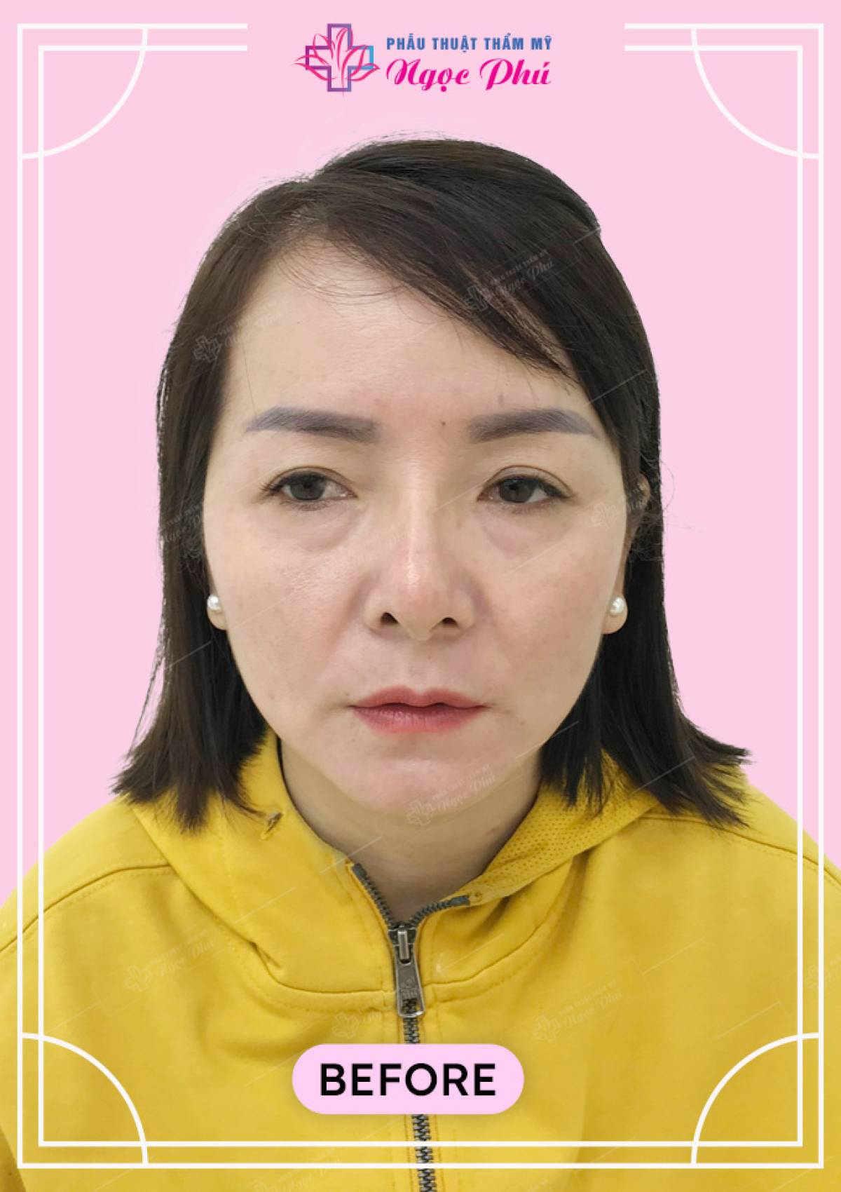 Cắt mắt Hàn Quốc