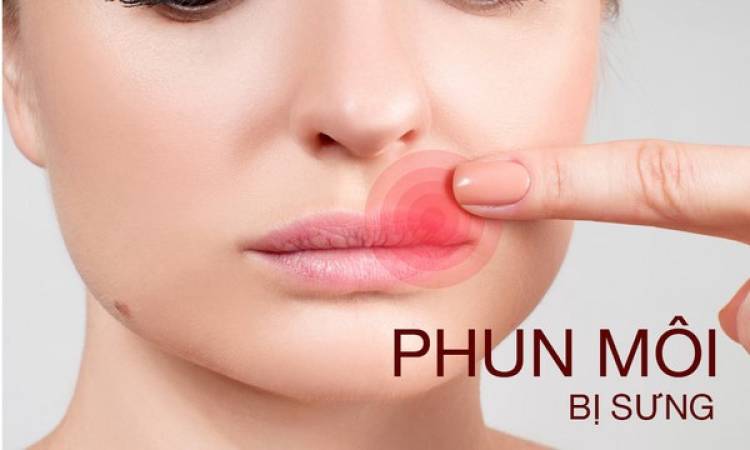 Mách bạn cách xử lý khi phun môi bị sưng