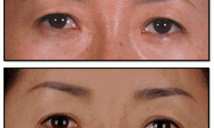 Nâng chân mày không phẫu thuật là gì?