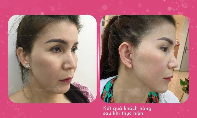 Tư Vấn Căng Da Mặt Vi Phẫu