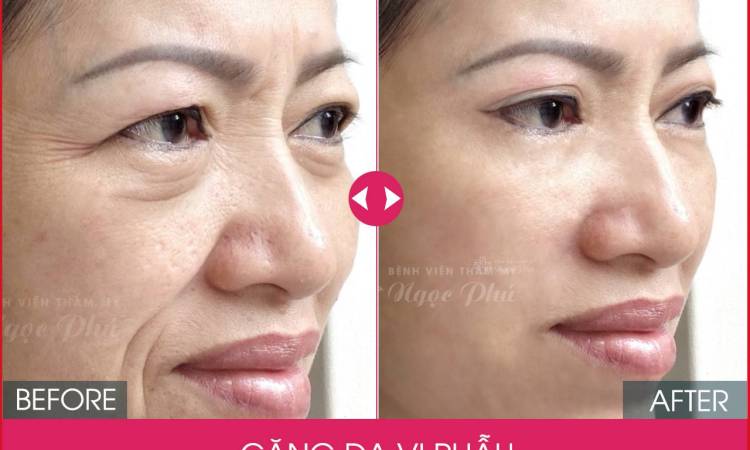 Căng da mặt ở đâu an toàn? Review từ khách hàng thực tế
