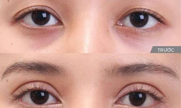 Phẫu thuật mắt 2 mí bao nhiêu tiền? Tham khảo chi phí cắt mí tại địa chỉ uy tín