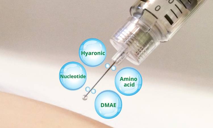 Tiêm Mesotherapy trị nám - Bí quyết vượt qua sự tự ti về làn da