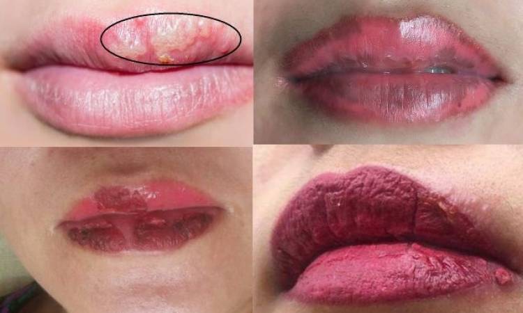 Dấu hiệu phun môi bị nhiễm trùng và cách xử lý