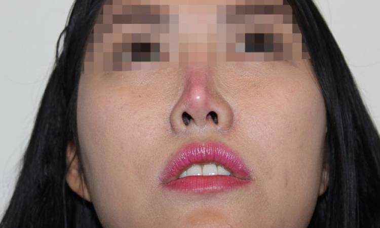 3 nguyên nhân và 2 cách khắc phục tình trạng nâng mũi 1 tháng vẫn đỏ đầu mũi