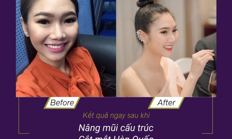 NÂNG MŨI AN TOÀN VỚI PHƯƠNG PHÁP NÀO ?