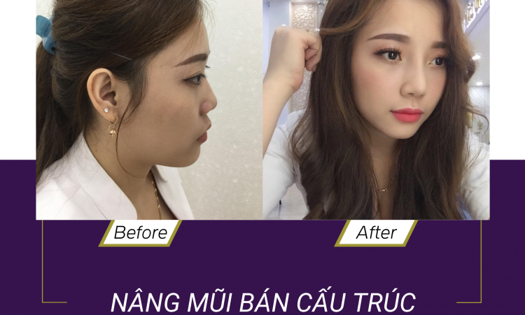 NÂNG MŨI CAO CÓ ẢNH HƯỞNG GÌ KHÔNG?