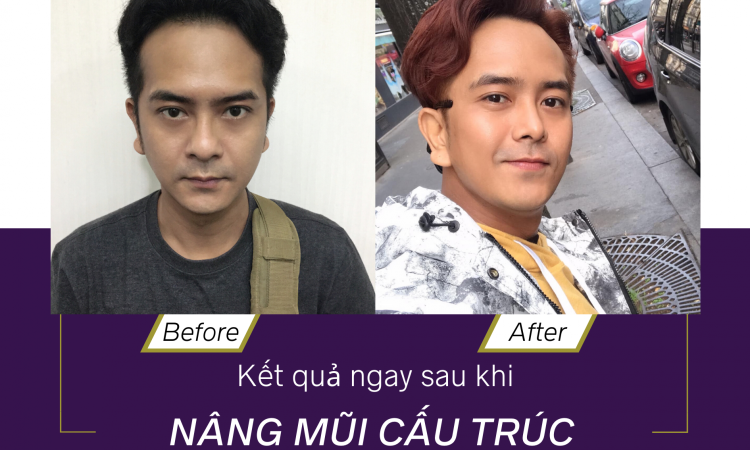 NÂNG MŨI ĐẸP TỰ NHIÊN KHÔNG?