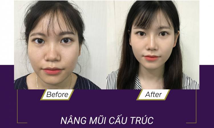 NÂNG MŨI UY TÍN TẠI BỆNH VIỆN NGỌC PHÚ