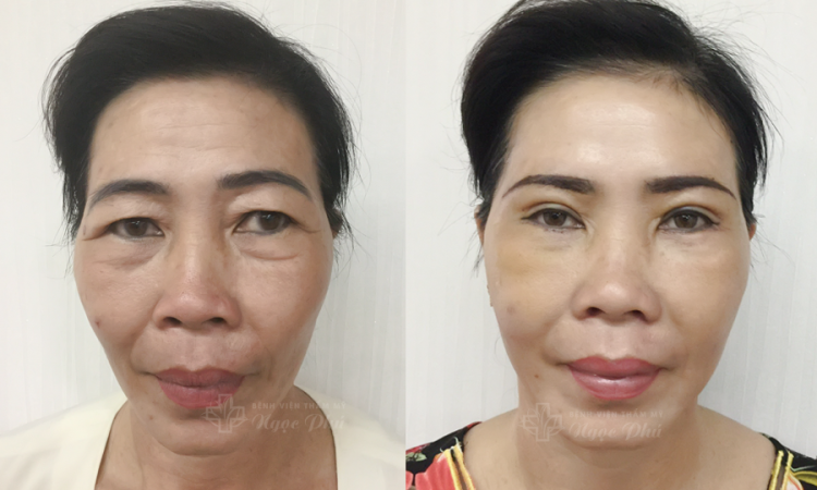 Giải đáp: Bao nhiêu tuổi thì nâng cung mày?
