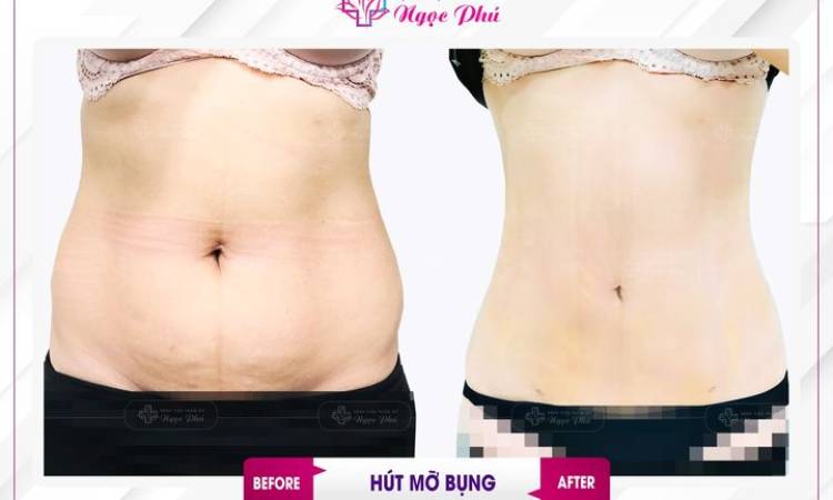 Review hút mỡ bụng - Ngủ dậy là có ngay vòng 2 thon gọn