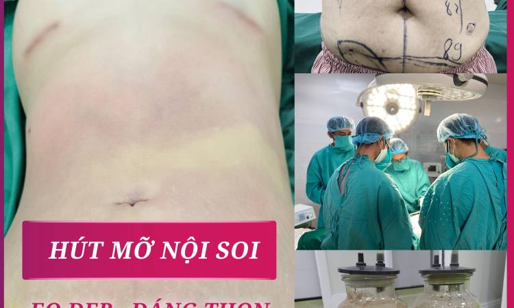 Hút mỡ bụng có nguy hiểm không? Có nên đi hút mỡ bụng