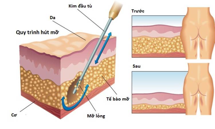 Tại sao hút mỡ bụng lại chết - Nguyên nhân do đâu?