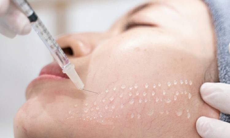Tiêm Mesotherapy giá bao nhiêu tiền? Những lợi ích không tưởng của công nghệ này