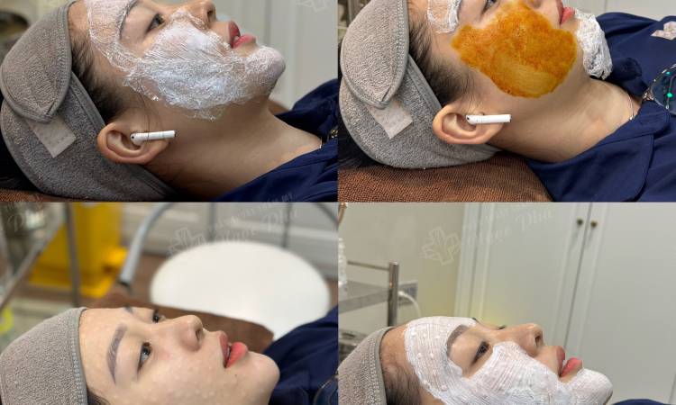 Cách để da mặt đẹp - an toàn với kỹ thuật tiêm Mesotherapy