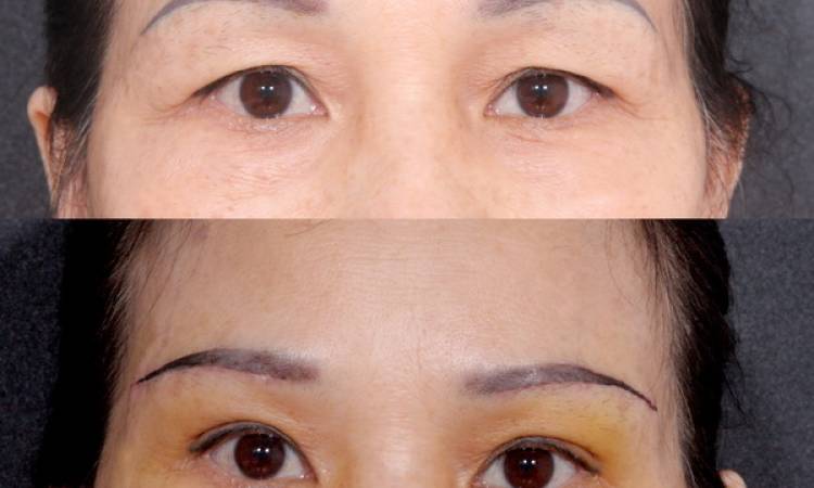 Tại sao phải nâng cung chân mày?