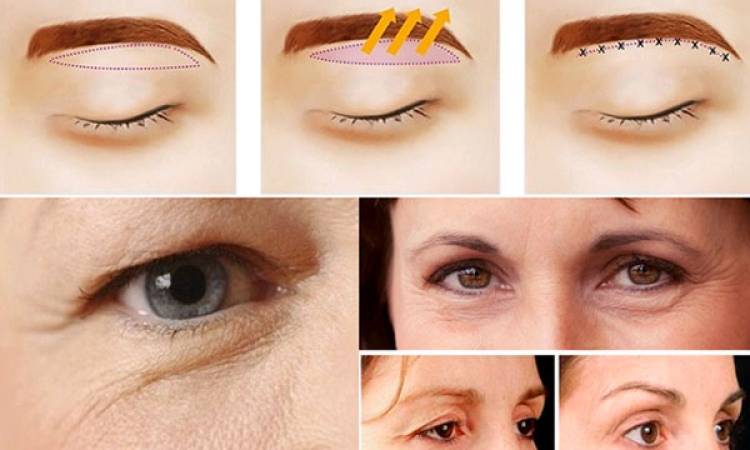 Nâng cung mày bao lâu hết sưng và đẹp tự nhiên?