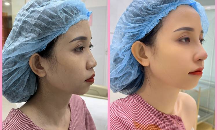 Nâng mũi cấu trúc Hàn Quốc và những điều cần biết
