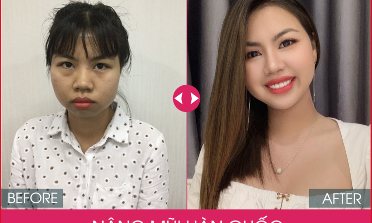 Giải đáp từ chuyên gia: Nâng mũi Hàn Quốc có vĩnh viễn không?