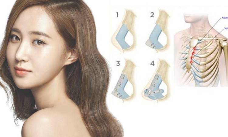 Nâng mũi tự thân - Cứu cánh cho những ca mũi hỏng, biến chứng