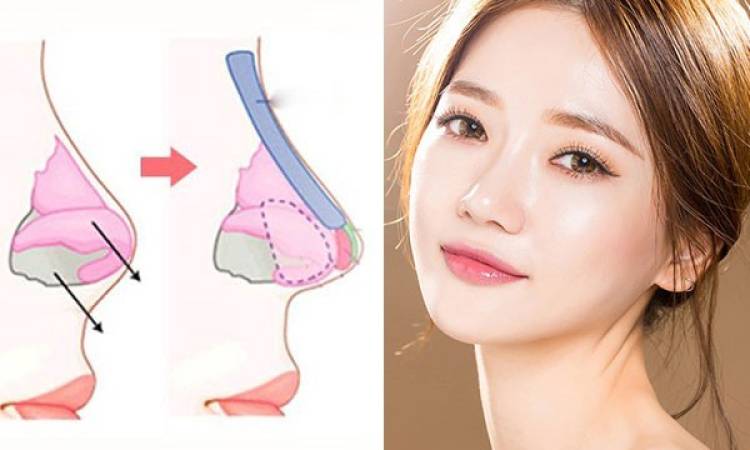 Bảng giá nâng mũi hot nhất 2023