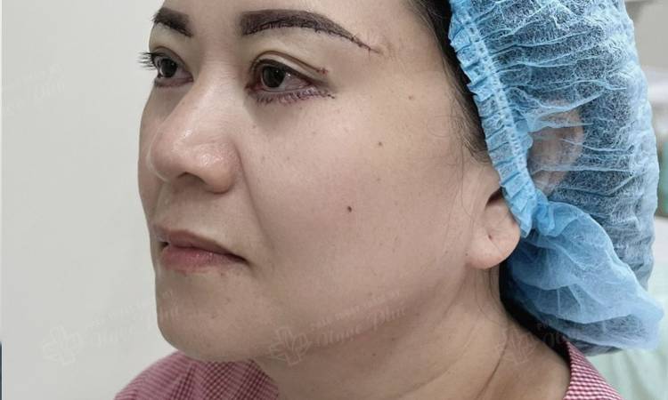 Cắt mí dưới có nguy hiểm không?