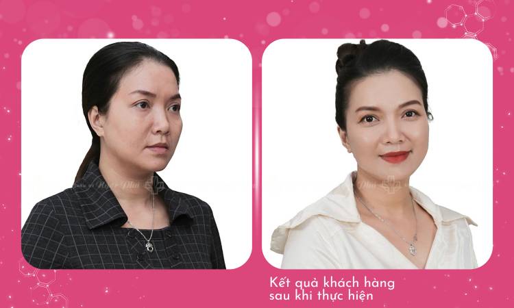 Tìm hiểu về phẫu thuật thẩm mỹ kéo căng da mặt