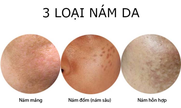 Meso nám và cơ chế hình thành của nám da