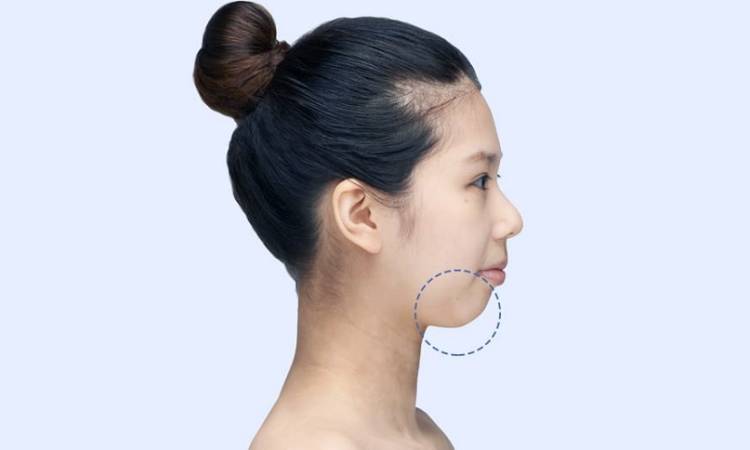 Cằm lẹm là gì? Có ảnh hưởng đến tướng số hay không?