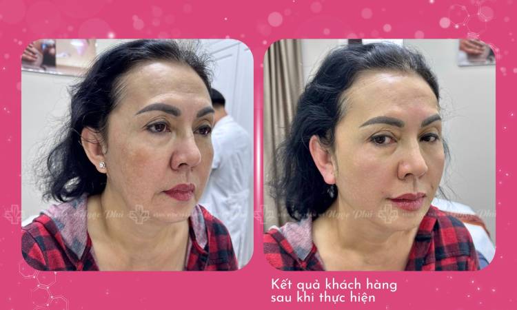 Căng da mặt bằng chỉ - Nâng cơ trẻ hóa toàn diện