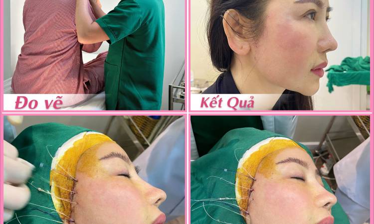 Giải đáp: Có nên thực hiện căng da mặt cho nam giới không?