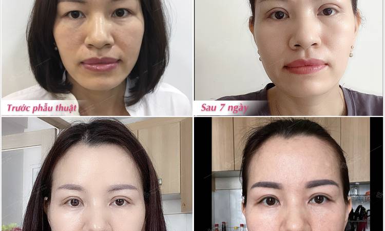 Cắt mí 6D và những điều cần biết