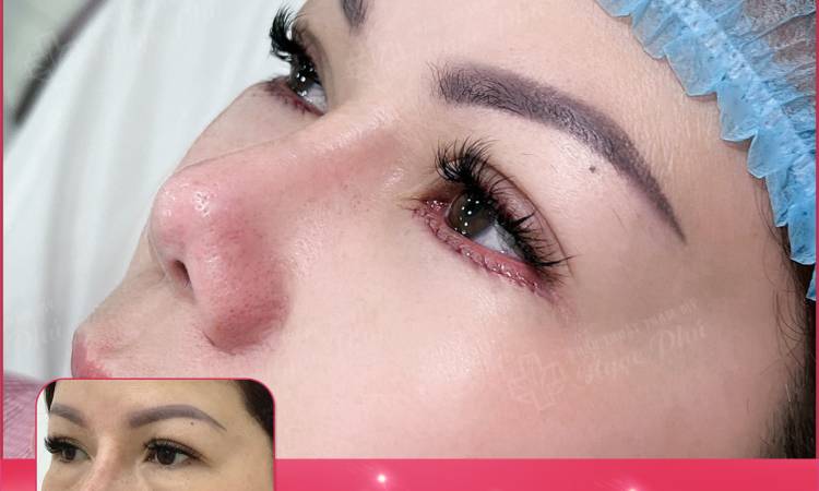 Cắt mí dưới để làm gì? Một số lưu ý cần nắm rõ trước phẫu thuật