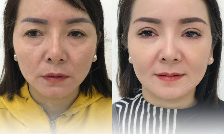 Cắt mí dưới mấy ngày cắt chỉ? Những điều cần viết về chăm sóc cắt mí