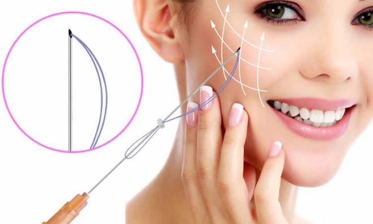 Tìm hiểu chi tiết về loại chỉ Collagen căng da mặt