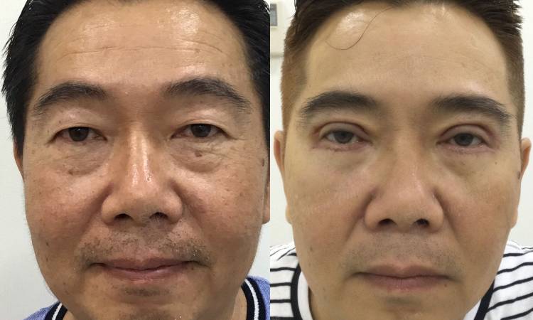 Có nên cắt mí dưới hay không và những điều nên biết trước khi thực hiện