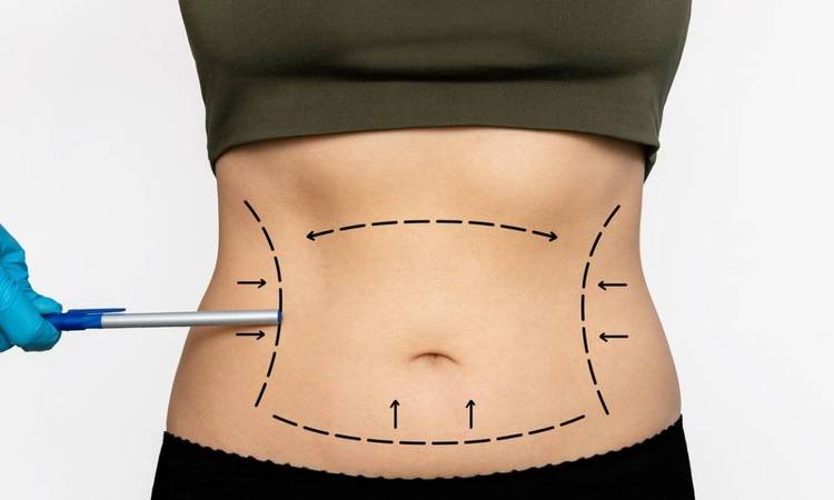 Hút mỡ không phẫu thuật có thật sự hiệu quả