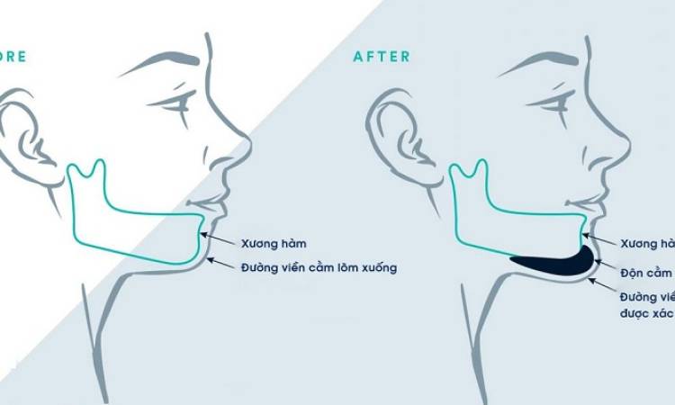 Độn cằm có nguy hiểm không? Các yếu tố quyết định sự thành công