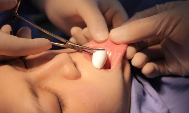 Kinh nghiệm độn cằm tròn thành cằm V-line