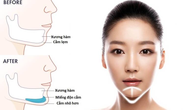 Độn cằm có ảnh hưởng gì không?