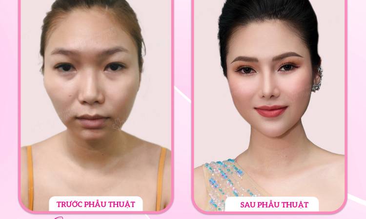 Bật mí gọt cằm có đau không? Cách chăm sóc hậu phẫu như thế nào?