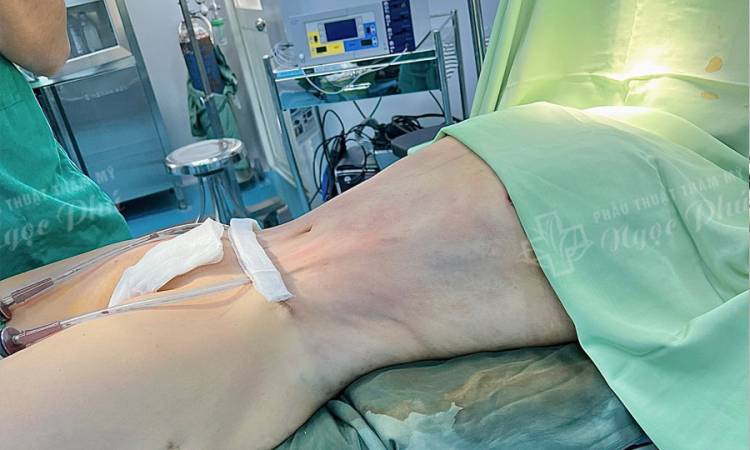 Giải đáp: Hút mỡ bụng có đau không?