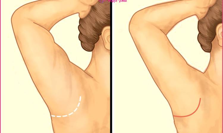 Hút mỡ nách - Giải pháp loại bỏ mỡ thừa dưới cánh tay chỉ trong vòng 1 nốt nhạc