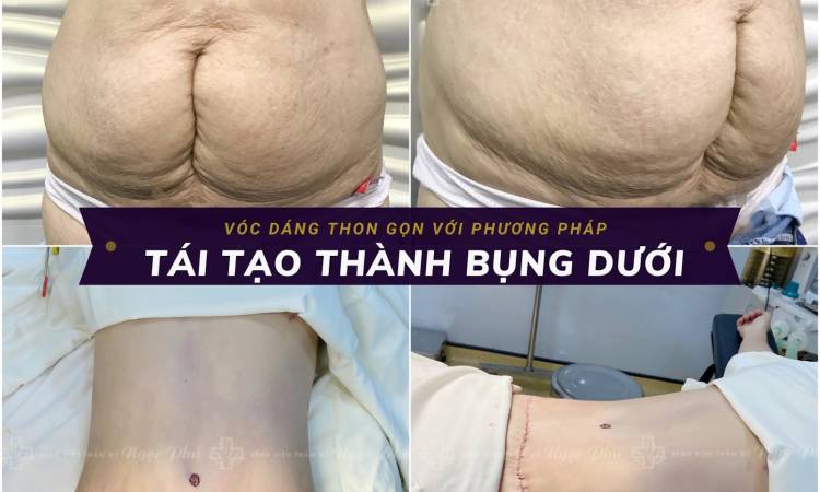 Hút mỡ tạo hình thành bụng có nguy hiểm không?