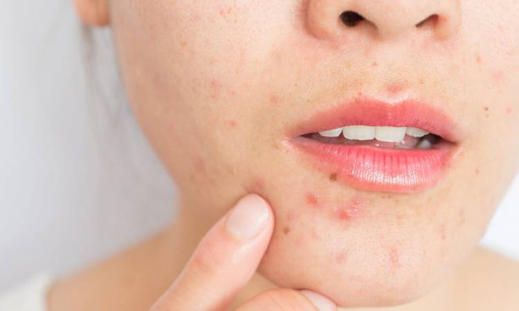 Meso Mụn là gì? Quy trình thực hiện