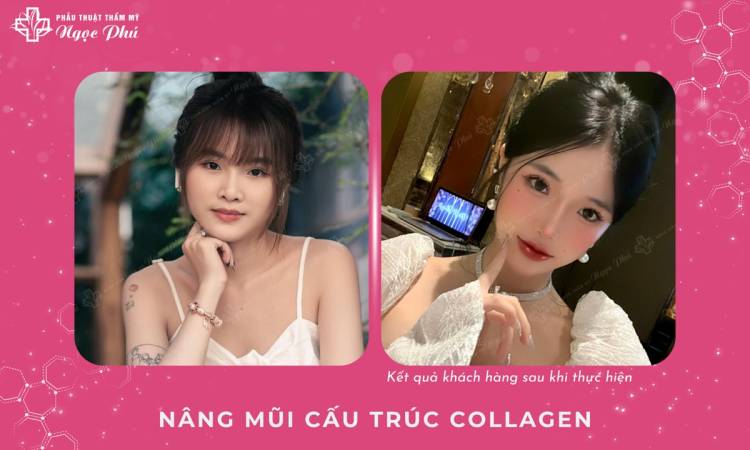 Nâng Mũi Cấu Trúc Có Vĩnh Viễn Không Bác Sĩ?