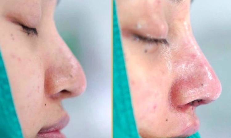 Tình Trạng Nâng Mũi Đầu Mũi Bị To Và Cách Khắc Phục