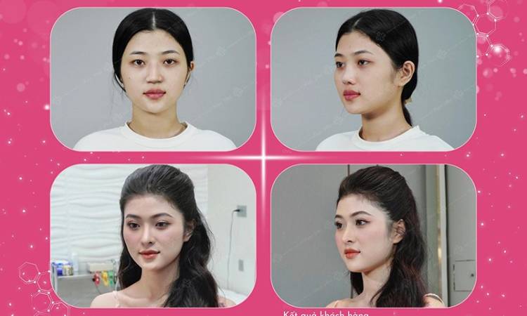 Gợi Ý 3+ Cách Nâng Mũi Tự Nhiên Rất Hài Hòa Với Khuôn Mặt