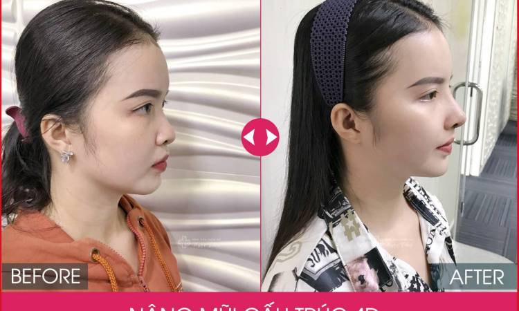NÂNG MŨI TỰ NHIÊN GIÁ BAO NHIÊU